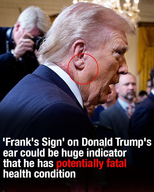 “Experts Say ‘Frank’s Sign’ on Trump’s Ear May Indicate Serious Health Risk”