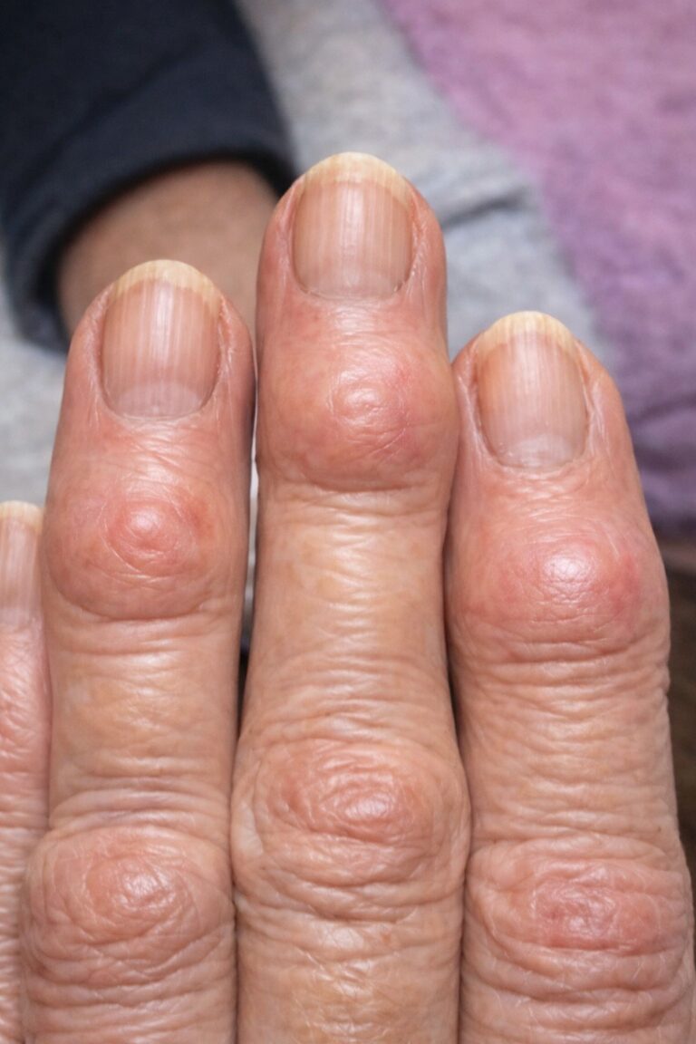 My grandma has these hard bumps forming on her finger joints near the nails. Why is this spreading?