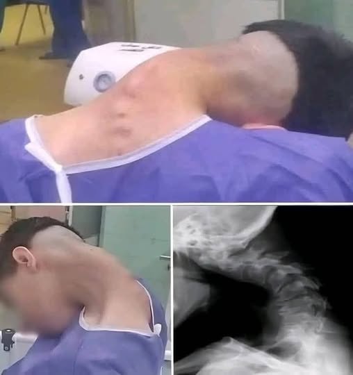 Young Man Hospitalized After Dropping His Phone — Doctors Issue a Warning