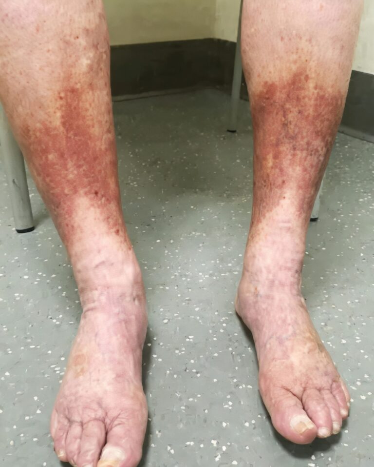 Swollen Feet? Here’s What Could Be Causing It and When to Get Help-
