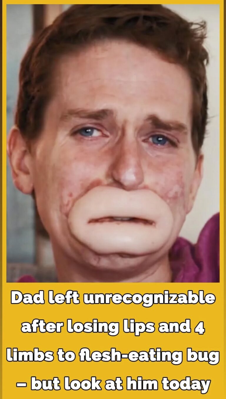 From Critical Illness to Recovery: A Father’s Journey After a Flesh-Eating Infection