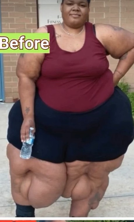 From Misdiagnosis to Strength: A Mother’s Journey Battling Lymphedema and Lipedema