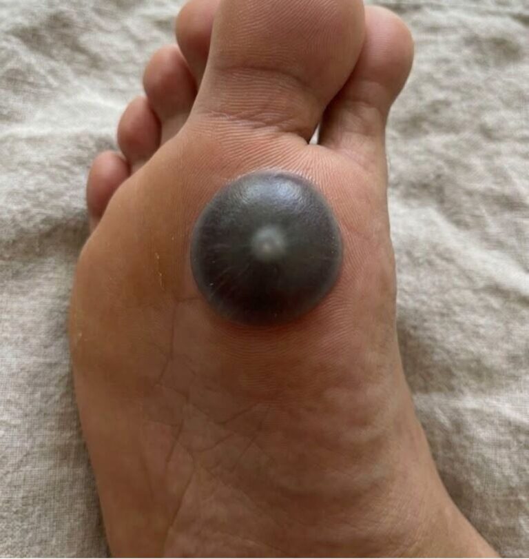 A Sudden Painful Spot Appeared on My Daughter’s Foot—Here’s What We Noticed