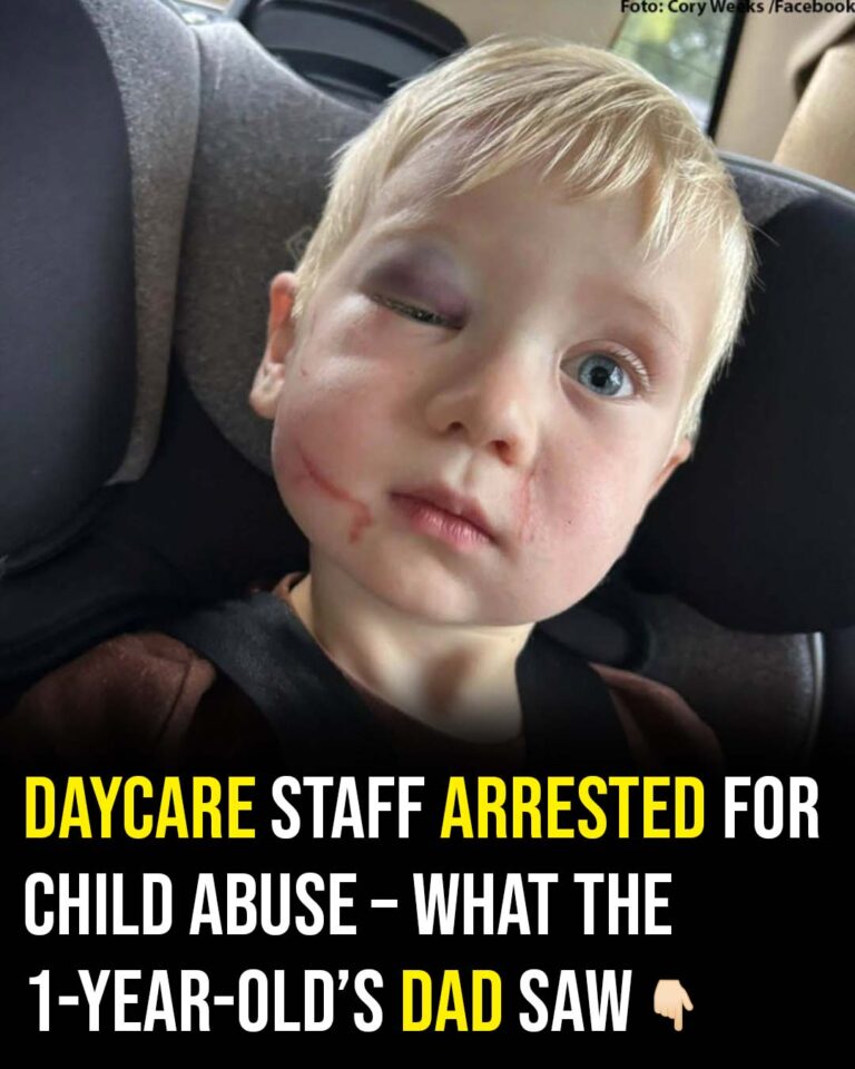 Daycare worker arrested after toddler arrives with black eye and swollen face on first day