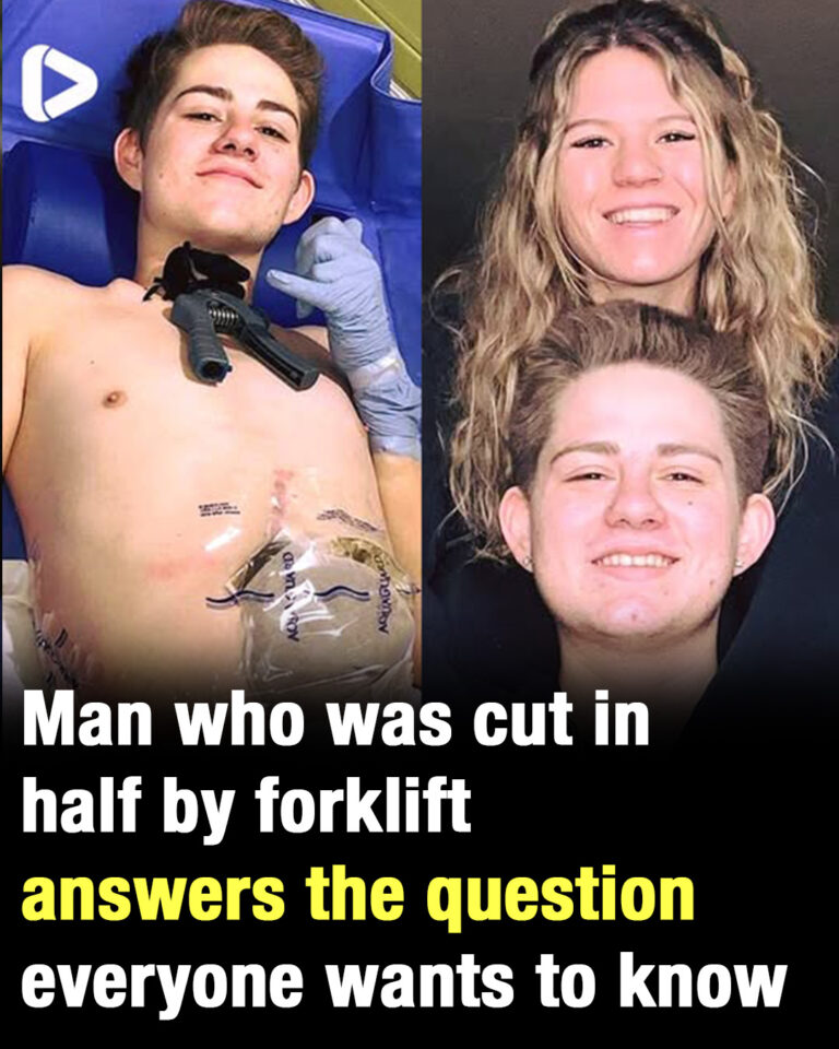 19-year-old crushed by forklift chooses to amputate bottom half of his body
