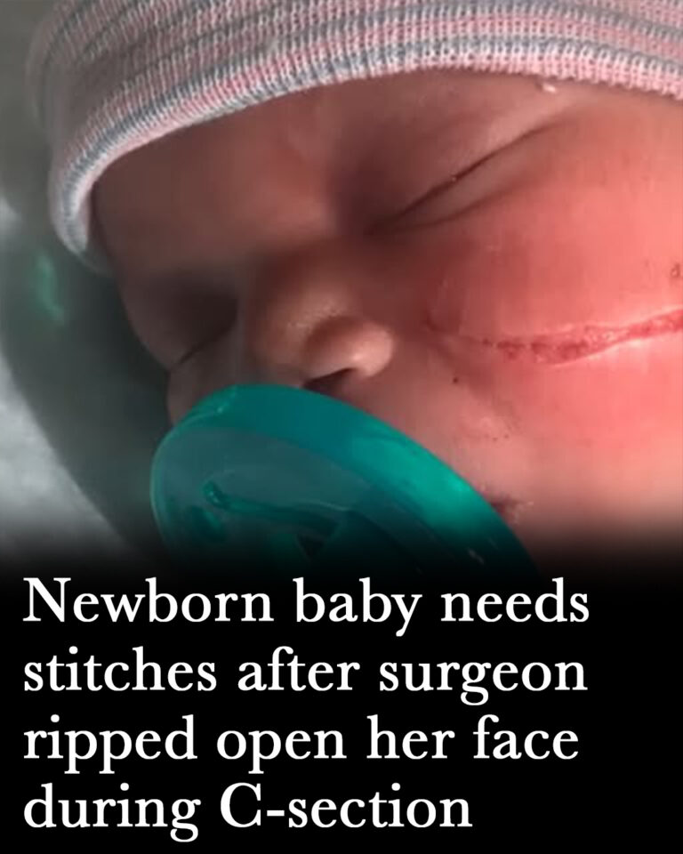 Newborn baby needs 13 stitches after surgeon ripped open her face during C-section